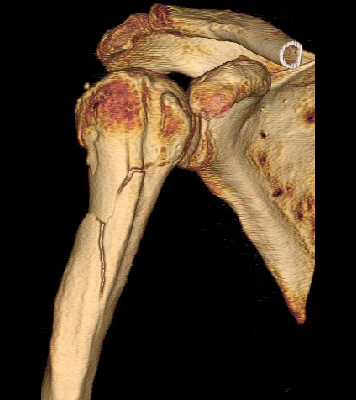 上腕骨近位端骨折(3D-CT)