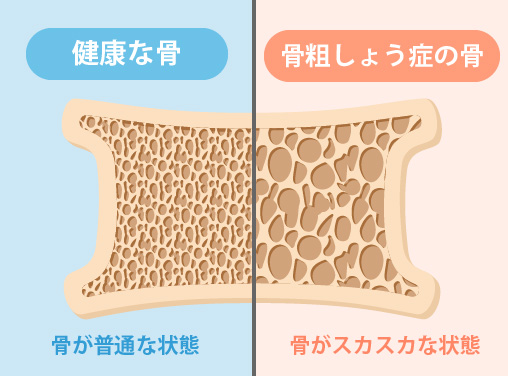 骨粗しょう症って?